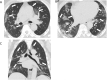 77-year-old male with COVID-19 presenting with five days of fever and cough. A, B, Axial and, C, coronal unenhanced thin-section chest CT images show bilateral ground-glass opacities (arrows) in a predominately peripheral distribution, and many with a rounded morphology.