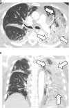 74-year-old male with COVID-19 presenting with seven days of cough. A, Axial and, B, coronal contrast-enhanced, thin-section chest CT images show diffuse GGO and consolidation in the left lung (arrows). These findings would be classified as “indeterminate” per the RSNA, BSTI, and COVID-19S assessment systems and as “Equivocal / Unsure” per CO-RADS.