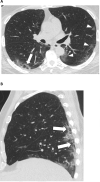57-year-old male with COVID-19 presenting with 4 days of cough. A, Axial and, B, sagittal unenhanced thin-section chest CT images show bilateral ground-glass opacities in a peripheral distribution in the left lung, some with a rounded morphology (arrowheads). There are also arcadelike opacities in the subpleural right lower lobe (arrow) indicative of a perilobular pattern of disease.