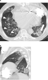 72-year-old male with COVID-19 and history of heart failure presenting with 10 days of cough. A, Axial and sagittal, B, unenhanced thin-section chest CT images show peribronchial ground-glass opacities (arrowheads) as well as ground-glass opacity in the left lower lobe with a ring of denser consolidation (reverse halo sign) (arrow).