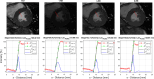 Quantification of edge sharpness. (Top) Axial noncontrast cardiac cine
MR images for each sequence type, with red profile line. (Bottom) Graphs
show the normalized intensity profile and regression line over the blood to
myocardium transition for edge sharpness determination. Cnorm = normalized
intensity profile, C̃norm = intensity profile used for edge sharpness
calculation, C'norm = first derivative of Cnorm' f(si) =
linear regression of intensity profile used for edge sharpness calculation,
LenProfile = length of profile line from blood pool to myocardium, 1RR = one
cardiac cycle cine sequence, Ref = reference sequence, s = distance, 6RR =
six cardiac cycles cine sequence, 3RR = three cardiac cycles cine
sequence.
