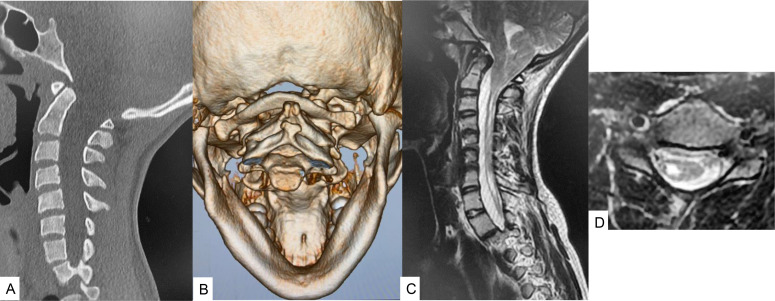 Accurate Posterior Fossa Decompression Technique for Chiari ...