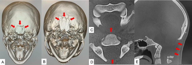 Accurate Posterior Fossa Decompression Technique for Chiari ...