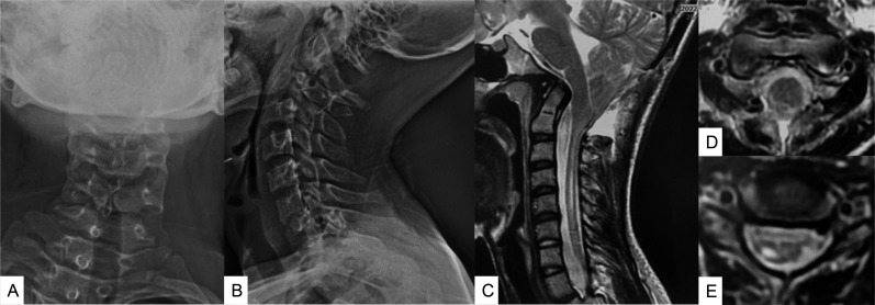 Accurate Posterior Fossa Decompression Technique for Chiari ...