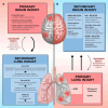 Diagram illustrating the cycle between brain and lung injuries. On the left, primary brain injury causes secondary lung injury through secondary insults like hypoxemia. On the right, primary lung injury leads to secondary brain injury via secondary insults like dysregulation of respiratory drive. Both primary brain injury and primary lung injury have their respective causes and effects detailed in bullet points within pink and blue boxes. The brain and lungs are depicted centrally, highlighting the connection between the two injury types.