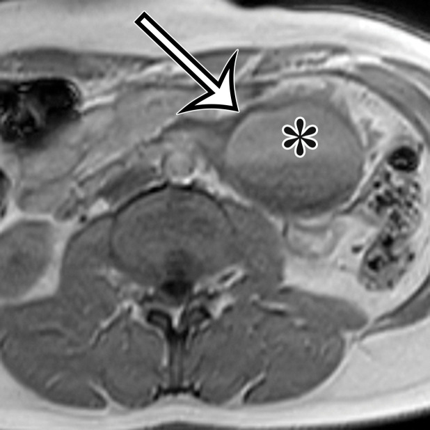 Chylolymphatic cyst in a 24-year-old woman with acute onset of abdominal pain, with gross pathologic correlation. (a) Axial contrast-enhanced CT image shows a well-circumscribed thin-walled cyst in the midabdomen (arrow) with a fat-fluid level. * = fat-containing chylous component. (b) Axial T1-weighted MR image shows that the fat-containing chylous component (*) of the cyst (arrow) is hyperintense. (c) Axial out-of-phase T1-weighted image shows diffuse loss of signal intensity in the fat-containing chylous component (*) of the cyst (arrow). (d) Photograph of the opened specimen shows a thin-walled unilocular cyst (arrow) with a small amount of residual thick milky yellow fluid (*).