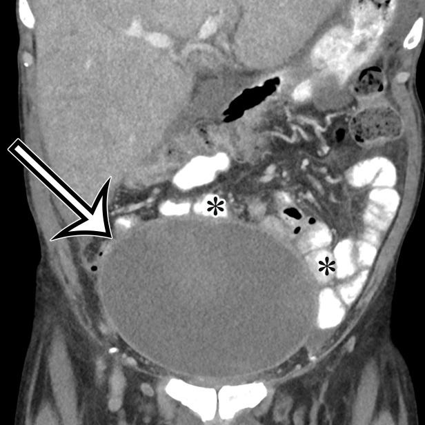 PSMC incidentally identified in a 68-year-old man, with pathologic correlation. (a) Coronal contrast-enhanced CT image shows a unilocular thin-walled cyst (arrow) in the midline pelvis, intimately associated with multiple small-bowel loops (*). There are no septa or solid components. (b) Photograph of the cut resected specimen shows the smooth thin tan cyst wall (arrow), with few internal blood products (*). (c) Low-power photomicrograph shows flattened cuboidal mesothelial cells lining the cyst with normal cytoplasm (arrow). (Hematoxylin-eosin [H-E] stain; original magnification, ×4.)