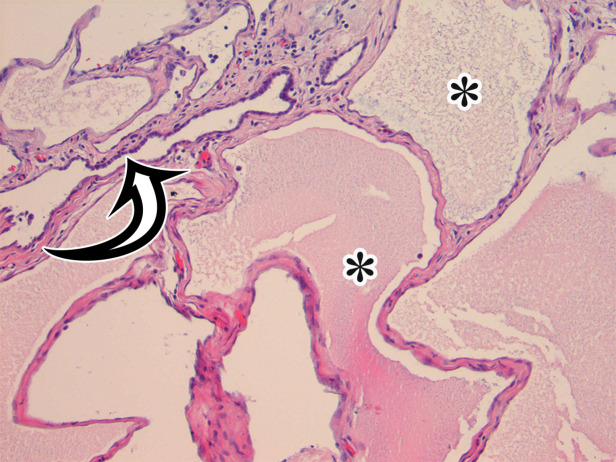 MCPM in a 34-year-old woman. (a–d) Axial (a), coronal (b), and sagittal (c) T2-weighted images and axial T1-weighted image (d) show a multiloculated cystic mass (straight arrow) with thin septa (arrowheads) in the pelvis. The mass arises from the pelvic peritoneum, infiltrates around bowel loops, and surrounds the right ovary. Most loculi contain simple T2-hyperintense fluid (* in a–c), which is hypointense on the T1-weighted image (* in d); however, one loculus (curved arrow in a and d) shows increased signal intensity on both T1-weighted and T2-weighted images, consistent with internal blood contents. Incidentally noted are T1-hyperintense hemorrhagic cysts in the right ovary (straight arrow in d); the lateral cyst contains layering T1-hyperintense blood products, and the superomedial cyst has a T2-hypointense rim (straight arrow in a). (e, f) Photographs of a whole (e) and cut (f) gross specimen show the multicystic nature of a peritoneal mesothelioma, with a grapelike appearance of the whole specimen (arrow in e). The cut specimen shows the mass to be comprised of innumerable cystic spaces of varying size separated by a thin fibrovascular stroma (arrowhead in f), which matches the appearance at MRI. (g, h) High-power photomicrographs with H-E stain (g) and calretinin immunohistochemical stain (h) show multiple small cystic spaces (*) lined by cuboidal mesothelium (arrow), which stains positive for calretinin, a mesothelial marker. (Original magnification, ×100.)