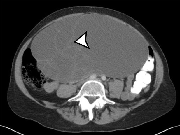 Spectrum of adnexal-origin cystic masses. (a) Axial T2-weighted image in a 67-year-old woman with right lower quadrant pain shows homogeneous hyperintense signal in a well-circumscribed unilocular thin-walled cyst (*), which was found to arise from the right ovary. Histologic analysis showed benign epithelium, consistent with serous cystadenoma. (b) Axial contrast-enhanced image in a 62-year-old woman with increasing abdominal girth shows a well-circumscribed multiloculated cyst with multiple thin septa (arrowhead) but no mural nodules. Surgically, the cyst was found to arise from the right ovary. Histologic analysis showed a single layer of mucinous epithelium, consistent with MCN. (c) Axial contrast-enhanced CT image in a 32-year-old woman with increasing abdominal pain shows a large multiloculated cystic mass (arrowheads) in the midline pelvis, which contains calcification (curved arrow) and fat (straight arrow) and is surrounded by ascites (*). The mass was found to arise from the left ovary. Histologically, it was shown to be a mature cystic teratoma.