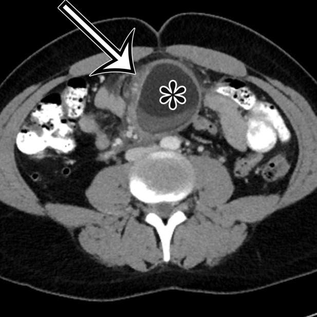 Chylolymphatic cyst in a 24-year-old woman with acute onset of abdominal pain, with gross pathologic correlation. (a) Axial contrast-enhanced CT image shows a well-circumscribed thin-walled cyst in the midabdomen (arrow) with a fat-fluid level. * = fat-containing chylous component. (b) Axial T1-weighted MR image shows that the fat-containing chylous component (*) of the cyst (arrow) is hyperintense. (c) Axial out-of-phase T1-weighted image shows diffuse loss of signal intensity in the fat-containing chylous component (*) of the cyst (arrow). (d) Photograph of the opened specimen shows a thin-walled unilocular cyst (arrow) with a small amount of residual thick milky yellow fluid (*).