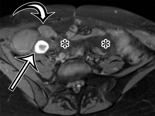 MCPM in a 34-year-old woman. (a–d) Axial (a), coronal (b), and sagittal (c) T2-weighted images and axial T1-weighted image (d) show a multiloculated cystic mass (straight arrow) with thin septa (arrowheads) in the pelvis. The mass arises from the pelvic peritoneum, infiltrates around bowel loops, and surrounds the right ovary. Most loculi contain simple T2-hyperintense fluid (* in a–c), which is hypointense on the T1-weighted image (* in d); however, one loculus (curved arrow in a and d) shows increased signal intensity on both T1-weighted and T2-weighted images, consistent with internal blood contents. Incidentally noted are T1-hyperintense hemorrhagic cysts in the right ovary (straight arrow in d); the lateral cyst contains layering T1-hyperintense blood products, and the superomedial cyst has a T2-hypointense rim (straight arrow in a). (e, f) Photographs of a whole (e) and cut (f) gross specimen show the multicystic nature of a peritoneal mesothelioma, with a grapelike appearance of the whole specimen (arrow in e). The cut specimen shows the mass to be comprised of innumerable cystic spaces of varying size separated by a thin fibrovascular stroma (arrowhead in f), which matches the appearance at MRI. (g, h) High-power photomicrographs with H-E stain (g) and calretinin immunohistochemical stain (h) show multiple small cystic spaces (*) lined by cuboidal mesothelium (arrow), which stains positive for calretinin, a mesothelial marker. (Original magnification, ×100.)