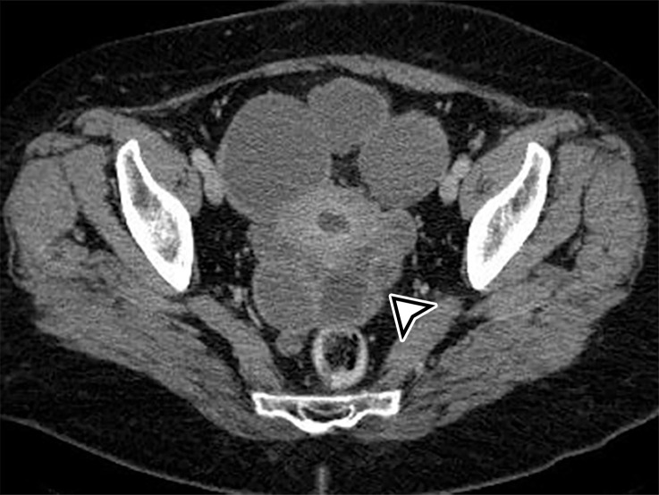 Peritoneal hydatidosis in an asymp­tomatic 49-year-old woman. (a, b) Axial CT images through the lower abdomen (a) and pelvis (b) show multiple well-circumscribed cystic lesions. The cyst along the posterior margin of the liver (arrow in a) has smooth mural calcifications. The cysts in the left upper quadrant (arrowhead in a) and pelvis (arrowhead in b) have a multiloculated appearance, with internal cysts of differing attenuation. (c) Sagittal T2-weighted image better shows the internal cyst architecture, including the floating inner membrane (straight arrow); the posterior pelvic cyst wall (curved arrow) is markedly T2 hypointense owing to the abundant collagen content. (d) Axial contrast-enhanced T1-weighted image shows enhancement of the thin walls and septa (arrow) but no internal nodularity or enhancement. Intraoperatively, there were innumerable hydatid cysts studding the peritoneum in addition to the multiple abdominal and pelvic cysts, consistent with disseminated hydatidosis, presumed secondary to a ruptured hepatic hydatid cyst.