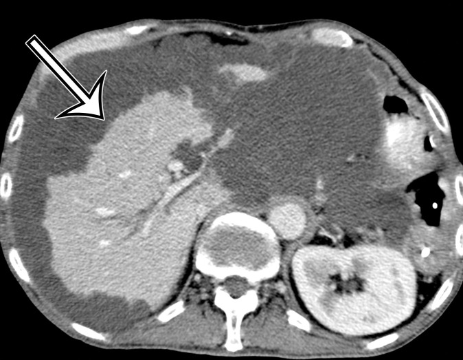 PMP in a 57-year-old man. (a) Sagittal US image shows masslike expansion of the omentum with echogenic septa (arrow) surrounded by hypoechoic gelatinous fluid. The subjacent bowel loops are displaced centrally. (b) Axial contrast-enhanced CT image shows low-attenuation fluid surrounding the liver and displacing the stomach, with scalloping of the hepatic surface (arrow), which represents extrinsic pressure from the mucinous implants. (c) Coronal T2-weighted image shows scalloping of the intraperitoneal visceral surfaces (straight arrow) and heterogeneous signal intensity of the fluid (curved arrow), which allow differentiation of PMP from simple ascites.