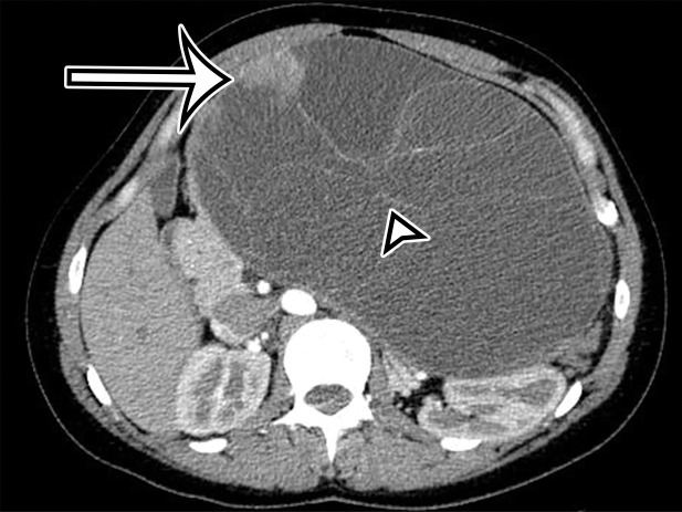 Pancreatic MCN in a 28-year-old woman with early satiety and increasing abdominal girth. (a) Axial contrast-enhanced CT image shows a large multiloculated thin-walled cystic mass in the anterior left upper quadrant with thin septa (arrowhead) and a solid nodular component (arrow). (b) Axial T2-weighted image shows a similar imaging appearance, with improved conspicuity of an additional solid nodule (curved arrow). Straight arrow = solid nodular component in a, arrowhead = septa. (c) Histologic image of the cyst wall shows columnar mucin-producing epithelium (arrowhead) with underlying ovarian stroma (*), a diagnostic feature of MCN. (H-E stain; original magnification, ×100.)