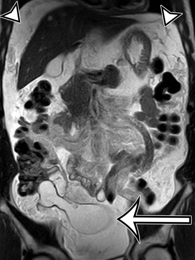 PMP (disseminated peritoneal adenomucinosis [DPAM]) in a 50-year-old man with progressive abdominal distention, early satiety, and weight loss due to a ruptured low-grade appendiceal mucinous neoplasm (LAMN). (a, b) Axial(a) and coronal (b) T2-weighted images show heterogeneously T2-hyperintense mucin (arrowheads) surrounding the liver and stomach, with subcapsular splenic implants (* in a). Close examination of the coronal image shows marked distention of the appendix (arrow in b) with a “pear” or “chicken drumstick” appearance. (c) Photograph of the cut resected spleen shows subcapsular splenic implants (*), which correlate with those seen at MRI. (d) Low-power photomicrograph of the appendix (H-E stain) shows loss of the normal mucosal architecture with proliferation of columnar mucinous epithelial cells (arrowhead), which produce mucinous content. The mucin (*) distends the appendiceal lumen and dissects through the ruptured wall (arrows), where it implanted diffusely along the peritoneal surface, leading to PMP.