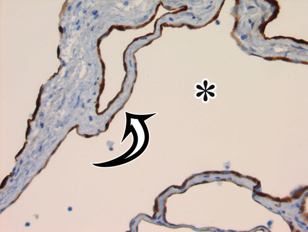 MCPM in a 34-year-old woman. (a–d) Axial (a), coronal (b), and sagittal (c) T2-weighted images and axial T1-weighted image (d) show a multiloculated cystic mass (straight arrow) with thin septa (arrowheads) in the pelvis. The mass arises from the pelvic peritoneum, infiltrates around bowel loops, and surrounds the right ovary. Most loculi contain simple T2-hyperintense fluid (* in a–c), which is hypointense on the T1-weighted image (* in d); however, one loculus (curved arrow in a and d) shows increased signal intensity on both T1-weighted and T2-weighted images, consistent with internal blood contents. Incidentally noted are T1-hyperintense hemorrhagic cysts in the right ovary (straight arrow in d); the lateral cyst contains layering T1-hyperintense blood products, and the superomedial cyst has a T2-hypointense rim (straight arrow in a). (e, f) Photographs of a whole (e) and cut (f) gross specimen show the multicystic nature of a peritoneal mesothelioma, with a grapelike appearance of the whole specimen (arrow in e). The cut specimen shows the mass to be comprised of innumerable cystic spaces of varying size separated by a thin fibrovascular stroma (arrowhead in f), which matches the appearance at MRI. (g, h) High-power photomicrographs with H-E stain (g) and calretinin immunohistochemical stain (h) show multiple small cystic spaces (*) lined by cuboidal mesothelium (arrow), which stains positive for calretinin, a mesothelial marker. (Original magnification, ×100.)