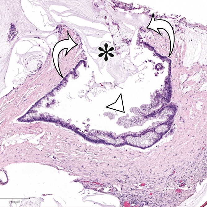 PMP (disseminated peritoneal adenomucinosis [DPAM]) in a 50-year-old man with progressive abdominal distention, early satiety, and weight loss due to a ruptured low-grade appendiceal mucinous neoplasm (LAMN). (a, b) Axial(a) and coronal (b) T2-weighted images show heterogeneously T2-hyperintense mucin (arrowheads) surrounding the liver and stomach, with subcapsular splenic implants (* in a). Close examination of the coronal image shows marked distention of the appendix (arrow in b) with a “pear” or “chicken drumstick” appearance. (c) Photograph of the cut resected spleen shows subcapsular splenic implants (*), which correlate with those seen at MRI. (d) Low-power photomicrograph of the appendix (H-E stain) shows loss of the normal mucosal architecture with proliferation of columnar mucinous epithelial cells (arrowhead), which produce mucinous content. The mucin (*) distends the appendiceal lumen and dissects through the ruptured wall (arrows), where it implanted diffusely along the peritoneal surface, leading to PMP.