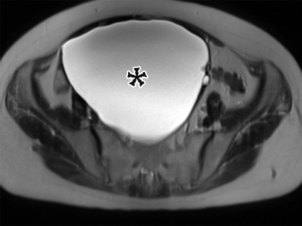 Spectrum of adnexal-origin cystic masses. (a) Axial T2-weighted image in a 67-year-old woman with right lower quadrant pain shows homogeneous hyperintense signal in a well-circumscribed unilocular thin-walled cyst (*), which was found to arise from the right ovary. Histologic analysis showed benign epithelium, consistent with serous cystadenoma. (b) Axial contrast-enhanced image in a 62-year-old woman with increasing abdominal girth shows a well-circumscribed multiloculated cyst with multiple thin septa (arrowhead) but no mural nodules. Surgically, the cyst was found to arise from the right ovary. Histologic analysis showed a single layer of mucinous epithelium, consistent with MCN. (c) Axial contrast-enhanced CT image in a 32-year-old woman with increasing abdominal pain shows a large multiloculated cystic mass (arrowheads) in the midline pelvis, which contains calcification (curved arrow) and fat (straight arrow) and is surrounded by ascites (*). The mass was found to arise from the left ovary. Histologically, it was shown to be a mature cystic teratoma.