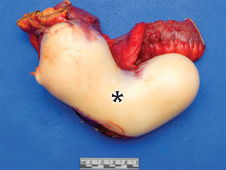 Appendiceal mucinous neoplasm in a 64-year-old man with right lower quadrant pain. (a) Coronal contrast-enhanced CT image shows marked distention of the appendix, with heterogeneous internal contents (*) and curvilinear calcification of the appendiceal wall (arrow). (b) Photograph of the intact resected specimen shows a mucin-distended rubbery appendix (*). Histopathologic analysis of the appendiceal wall demonstrated tall columnar mucinous bland epithelium, seen with low-grade appendiceal mucinous neoplasms (LAMNs) (Fig E6).