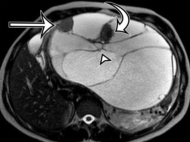 Pancreatic MCN in a 28-year-old woman with early satiety and increasing abdominal girth. (a) Axial contrast-enhanced CT image shows a large multiloculated thin-walled cystic mass in the anterior left upper quadrant with thin septa (arrowhead) and a solid nodular component (arrow). (b) Axial T2-weighted image shows a similar imaging appearance, with improved conspicuity of an additional solid nodule (curved arrow). Straight arrow = solid nodular component in a, arrowhead = septa. (c) Histologic image of the cyst wall shows columnar mucin-producing epithelium (arrowhead) with underlying ovarian stroma (*), a diagnostic feature of MCN. (H-E stain; original magnification, ×100.)