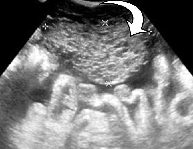 PMP in a 57-year-old man. (a) Sagittal US image shows masslike expansion of the omentum with echogenic septa (arrow) surrounded by hypoechoic gelatinous fluid. The subjacent bowel loops are displaced centrally. (b) Axial contrast-enhanced CT image shows low-attenuation fluid surrounding the liver and displacing the stomach, with scalloping of the hepatic surface (arrow), which represents extrinsic pressure from the mucinous implants. (c) Coronal T2-weighted image shows scalloping of the intraperitoneal visceral surfaces (straight arrow) and heterogeneous signal intensity of the fluid (curved arrow), which allow differentiation of PMP from simple ascites.