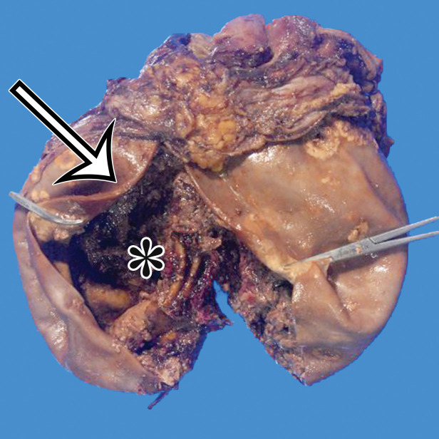 PSMC incidentally identified in a 68-year-old man, with pathologic correlation. (a) Coronal contrast-enhanced CT image shows a unilocular thin-walled cyst (arrow) in the midline pelvis, intimately associated with multiple small-bowel loops (*). There are no septa or solid components. (b) Photograph of the cut resected specimen shows the smooth thin tan cyst wall (arrow), with few internal blood products (*). (c) Low-power photomicrograph shows flattened cuboidal mesothelial cells lining the cyst with normal cytoplasm (arrow). (Hematoxylin-eosin [H-E] stain; original magnification, ×4.)