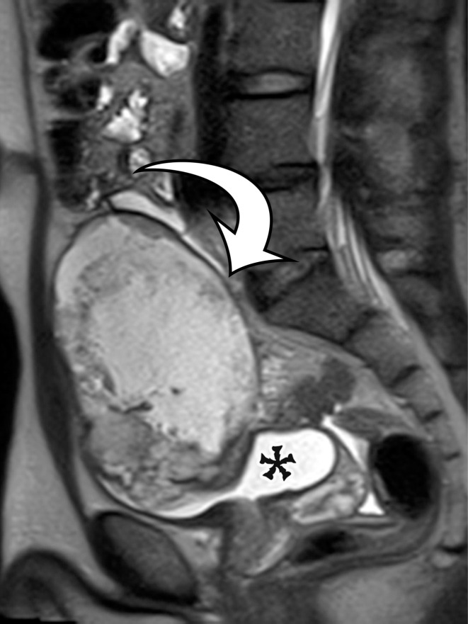 Spectrum of urachus-origin cystic lesions. (a) Urachal sinus in a 44-year-old man with sanguineous fluid draining from the umbilicus. Sagittal CT image shows a fluid-filled tubular structure (arrow) just deep to the anterior abdominal wall, extending from the umbilicus (arrowhead) to the bladder dome (*). (b) Urachal adenocarcinoma arising in a urachal diverticulum in a 57-year-old man. Sagittal T2-weighted image shows a large heterogeneous cystic mass (arrow) just deep to the anterior abdominal wall, which exerts mass effect on the bladder dome (*). (See Fig E10 for additional images.)