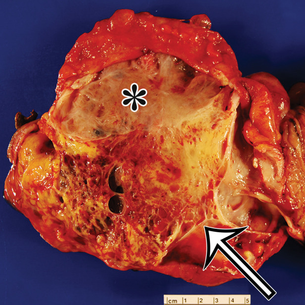 Cystic lymphangioma in a 33-year-old woman with a 2-week history of right lower quadrant pain, with pathologic correlation. (a, b) Transverse US (a) and axial contrast-enhanced CT (b) images show a thin-walled multiloculated cyst containing thin septa (arrow) that insinuates around the colon.(c) Photograph of the cut gross specimen shows the multilocular nature of the lymphangioma, with cystic spaces of varying size (*) and thin septa (arrow). (d) Photomicrograph of a cystic lymphangioma shows multiple thin-walled cystic spaces lined with endothelial cells and containing lymph (*). (MRI features are shown in Figure E1.)