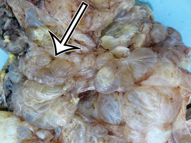 MCPM in a 34-year-old woman. (a–d) Axial (a), coronal (b), and sagittal (c) T2-weighted images and axial T1-weighted image (d) show a multiloculated cystic mass (straight arrow) with thin septa (arrowheads) in the pelvis. The mass arises from the pelvic peritoneum, infiltrates around bowel loops, and surrounds the right ovary. Most loculi contain simple T2-hyperintense fluid (* in a–c), which is hypointense on the T1-weighted image (* in d); however, one loculus (curved arrow in a and d) shows increased signal intensity on both T1-weighted and T2-weighted images, consistent with internal blood contents. Incidentally noted are T1-hyperintense hemorrhagic cysts in the right ovary (straight arrow in d); the lateral cyst contains layering T1-hyperintense blood products, and the superomedial cyst has a T2-hypointense rim (straight arrow in a). (e, f) Photographs of a whole (e) and cut (f) gross specimen show the multicystic nature of a peritoneal mesothelioma, with a grapelike appearance of the whole specimen (arrow in e). The cut specimen shows the mass to be comprised of innumerable cystic spaces of varying size separated by a thin fibrovascular stroma (arrowhead in f), which matches the appearance at MRI. (g, h) High-power photomicrographs with H-E stain (g) and calretinin immunohistochemical stain (h) show multiple small cystic spaces (*) lined by cuboidal mesothelium (arrow), which stains positive for calretinin, a mesothelial marker. (Original magnification, ×100.)