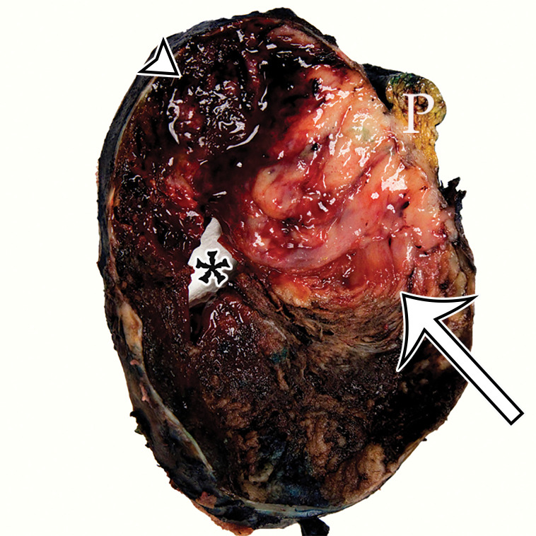 Pancreatic solid-pseudopapillary neoplasm (SPN) in a 42-year-old woman. (a) Coronal contrast-enhanced CT image shows a large solid (arrow) and cystic (*) tumor centered in the left upper quadrant, but of unclear origin. (b) Photograph of the cut resected specimen shows that the tumor arises from the pancreas (P). The tan-pink viable tissue (arrow) corresponds to the area of solid components seen at CT, and the hemorrhagic (arrowhead) and cystic necrotic (*) components correspond to similar areas seen at CT.