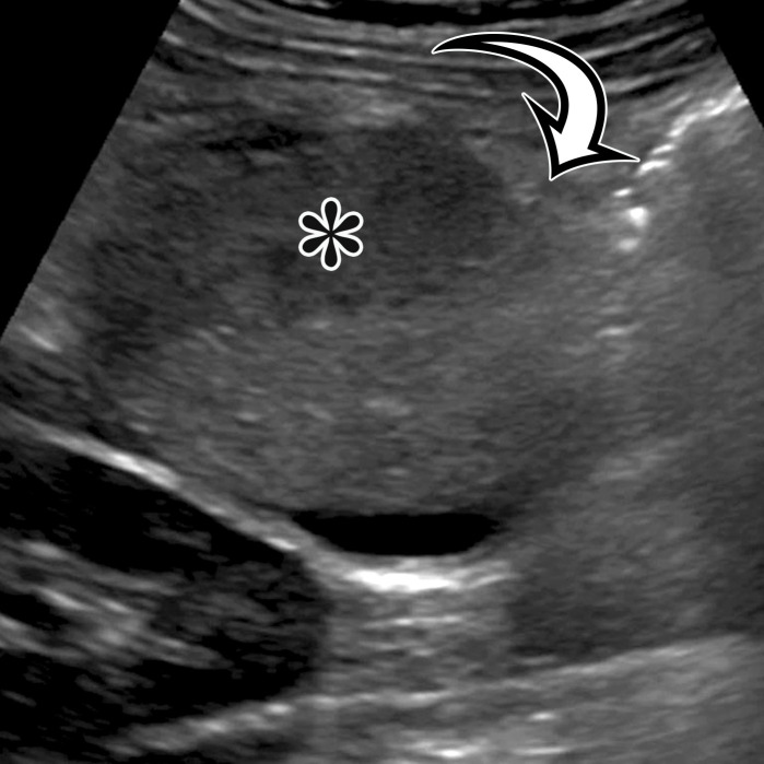 Nonpancreatic pseudocyst in a 40-year-old woman with sudden onset of severe right upper abdominal pain, with pathologic correlation.(a, b) Sagittal US (a) and axial contrast-enhanced CT (b) images show a well-circumscribed complex cystic lesion centered in the left mesentery (arrow). There is a fluid-fluid level (*), with chylous fluid layering nondependently. (c) Photograph of the resected specimen shows thick yellow fluid oozing from the incised surface. (d) Low-power photomicrograph (H-E stain) shows the thick fibrous cyst wall containing cholesterol crystals (arrowhead) and lymphocytes (*), with no epithelium (arrow). Pseudocysts occur when a fibrous wall forms around fluid or a foreign body and lack a true lining.