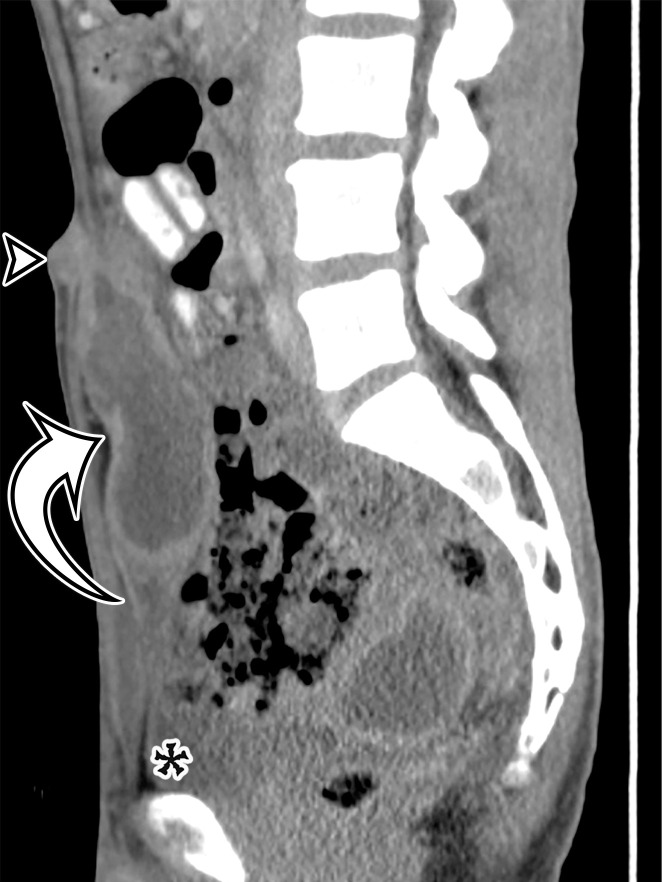 Spectrum of urachus-origin cystic lesions. (a) Urachal sinus in a 44-year-old man with sanguineous fluid draining from the umbilicus. Sagittal CT image shows a fluid-filled tubular structure (arrow) just deep to the anterior abdominal wall, extending from the umbilicus (arrowhead) to the bladder dome (*). (b) Urachal adenocarcinoma arising in a urachal diverticulum in a 57-year-old man. Sagittal T2-weighted image shows a large heterogeneous cystic mass (arrow) just deep to the anterior abdominal wall, which exerts mass effect on the bladder dome (*). (See Fig E10 for additional images.)