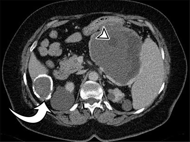 Peritoneal hydatidosis in an asymp­tomatic 49-year-old woman. (a, b) Axial CT images through the lower abdomen (a) and pelvis (b) show multiple well-circumscribed cystic lesions. The cyst along the posterior margin of the liver (arrow in a) has smooth mural calcifications. The cysts in the left upper quadrant (arrowhead in a) and pelvis (arrowhead in b) have a multiloculated appearance, with internal cysts of differing attenuation. (c) Sagittal T2-weighted image better shows the internal cyst architecture, including the floating inner membrane (straight arrow); the posterior pelvic cyst wall (curved arrow) is markedly T2 hypointense owing to the abundant collagen content. (d) Axial contrast-enhanced T1-weighted image shows enhancement of the thin walls and septa (arrow) but no internal nodularity or enhancement. Intraoperatively, there were innumerable hydatid cysts studding the peritoneum in addition to the multiple abdominal and pelvic cysts, consistent with disseminated hydatidosis, presumed secondary to a ruptured hepatic hydatid cyst.