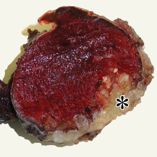 PMP (disseminated peritoneal adenomucinosis [DPAM]) in a 50-year-old man with progressive abdominal distention, early satiety, and weight loss due to a ruptured low-grade appendiceal mucinous neoplasm (LAMN). (a, b) Axial(a) and coronal (b) T2-weighted images show heterogeneously T2-hyperintense mucin (arrowheads) surrounding the liver and stomach, with subcapsular splenic implants (* in a). Close examination of the coronal image shows marked distention of the appendix (arrow in b) with a “pear” or “chicken drumstick” appearance. (c) Photograph of the cut resected spleen shows subcapsular splenic implants (*), which correlate with those seen at MRI. (d) Low-power photomicrograph of the appendix (H-E stain) shows loss of the normal mucosal architecture with proliferation of columnar mucinous epithelial cells (arrowhead), which produce mucinous content. The mucin (*) distends the appendiceal lumen and dissects through the ruptured wall (arrows), where it implanted diffusely along the peritoneal surface, leading to PMP.