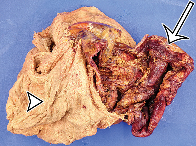 Foreign body in a 20-year-old man with an enlarging abdominal mass and a history of gunshot wound to the abdomen 7 years earlier. (a) Axial contrast-enhanced CT image shows a large complex thick-walled cystic structure (arrow) in the anterior abdomen. There are thin nonenhancing undulating internal septa (arrowhead) but no radiopaque marker. (b) Photograph of the gross resected specimen shows that the linear septa correlate with the folds of a surgical towel (arrowhead), encapsulated by a thick fibrous wall (arrow). (c) High-power photomicrograph (H-E stain) shows giant cells with invaginated (black arrowhead) and encased (white arrowhead) synthetic fibers.