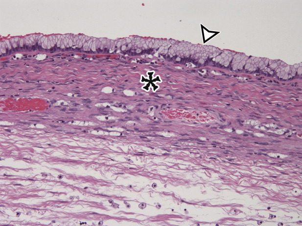 Pancreatic MCN in a 28-year-old woman with early satiety and increasing abdominal girth. (a) Axial contrast-enhanced CT image shows a large multiloculated thin-walled cystic mass in the anterior left upper quadrant with thin septa (arrowhead) and a solid nodular component (arrow). (b) Axial T2-weighted image shows a similar imaging appearance, with improved conspicuity of an additional solid nodule (curved arrow). Straight arrow = solid nodular component in a, arrowhead = septa. (c) Histologic image of the cyst wall shows columnar mucin-producing epithelium (arrowhead) with underlying ovarian stroma (*), a diagnostic feature of MCN. (H-E stain; original magnification, ×100.)