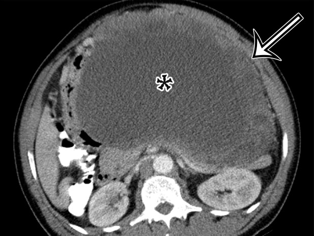 Spectrum of cystic gastrointestinal stromal tumor (GIST) at axial contrast-enhanced CT. (a) Axial contrast-enhanced CT image in a 35-year-old woman with right-sided bulging of the abdomen shows a large unilocular thick-walled cyst in the right abdomen (arrow) with no obvious site of origin. The internal contents have heterogeneous attenuation (*). (b) Axial contrast-enhanced CT image in a 61-year-old man with new-onset abdominal pain similarly shows a large predominantly unilocular cystic mass (*) in the anterior abdomen, with a thick wall (arrow) and mass effect on the pancreas and stomach but no clear site of origin. (c) Axial contrast-enhanced CT image in a 50-year-old woman shows a solid and cystic mass in the anterior abdomen. The cystic components (*) are more loculated, with thick walls and large solid components (arrow), consistent with cystic degeneration of a high-risk GIST.