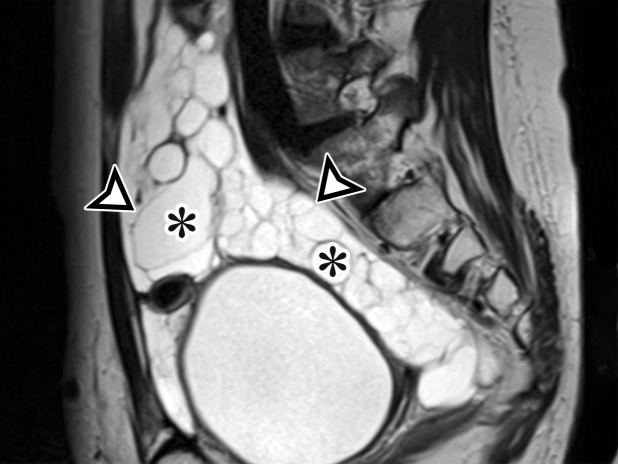 MCPM in a 34-year-old woman. (a–d) Axial (a), coronal (b), and sagittal (c) T2-weighted images and axial T1-weighted image (d) show a multiloculated cystic mass (straight arrow) with thin septa (arrowheads) in the pelvis. The mass arises from the pelvic peritoneum, infiltrates around bowel loops, and surrounds the right ovary. Most loculi contain simple T2-hyperintense fluid (* in a–c), which is hypointense on the T1-weighted image (* in d); however, one loculus (curved arrow in a and d) shows increased signal intensity on both T1-weighted and T2-weighted images, consistent with internal blood contents. Incidentally noted are T1-hyperintense hemorrhagic cysts in the right ovary (straight arrow in d); the lateral cyst contains layering T1-hyperintense blood products, and the superomedial cyst has a T2-hypointense rim (straight arrow in a). (e, f) Photographs of a whole (e) and cut (f) gross specimen show the multicystic nature of a peritoneal mesothelioma, with a grapelike appearance of the whole specimen (arrow in e). The cut specimen shows the mass to be comprised of innumerable cystic spaces of varying size separated by a thin fibrovascular stroma (arrowhead in f), which matches the appearance at MRI. (g, h) High-power photomicrographs with H-E stain (g) and calretinin immunohistochemical stain (h) show multiple small cystic spaces (*) lined by cuboidal mesothelium (arrow), which stains positive for calretinin, a mesothelial marker. (Original magnification, ×100.)