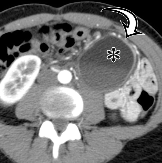 Nonpancreatic pseudocyst in a 40-year-old woman with sudden onset of severe right upper abdominal pain, with pathologic correlation.(a, b) Sagittal US (a) and axial contrast-enhanced CT (b) images show a well-circumscribed complex cystic lesion centered in the left mesentery (arrow). There is a fluid-fluid level (*), with chylous fluid layering nondependently. (c) Photograph of the resected specimen shows thick yellow fluid oozing from the incised surface. (d) Low-power photomicrograph (H-E stain) shows the thick fibrous cyst wall containing cholesterol crystals (arrowhead) and lymphocytes (*), with no epithelium (arrow). Pseudocysts occur when a fibrous wall forms around fluid or a foreign body and lack a true lining.