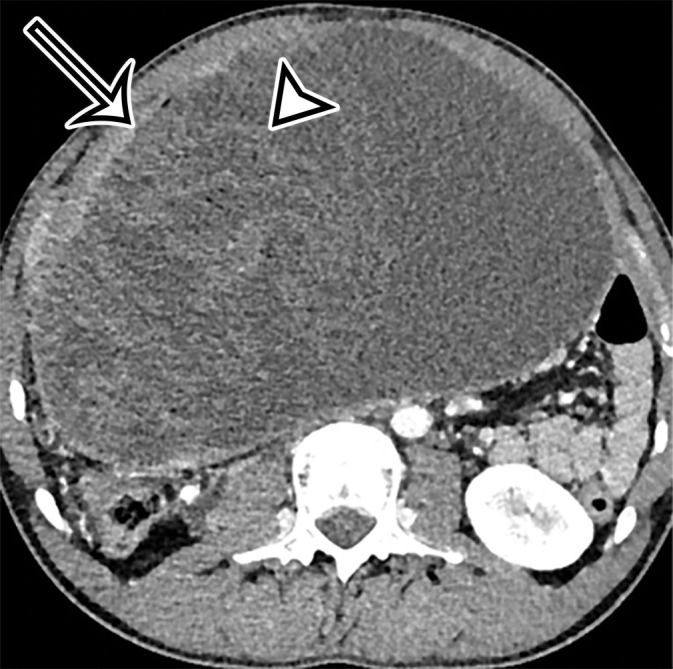 Foreign body in a 20-year-old man with an enlarging abdominal mass and a history of gunshot wound to the abdomen 7 years earlier. (a) Axial contrast-enhanced CT image shows a large complex thick-walled cystic structure (arrow) in the anterior abdomen. There are thin nonenhancing undulating internal septa (arrowhead) but no radiopaque marker. (b) Photograph of the gross resected specimen shows that the linear septa correlate with the folds of a surgical towel (arrowhead), encapsulated by a thick fibrous wall (arrow). (c) High-power photomicrograph (H-E stain) shows giant cells with invaginated (black arrowhead) and encased (white arrowhead) synthetic fibers.