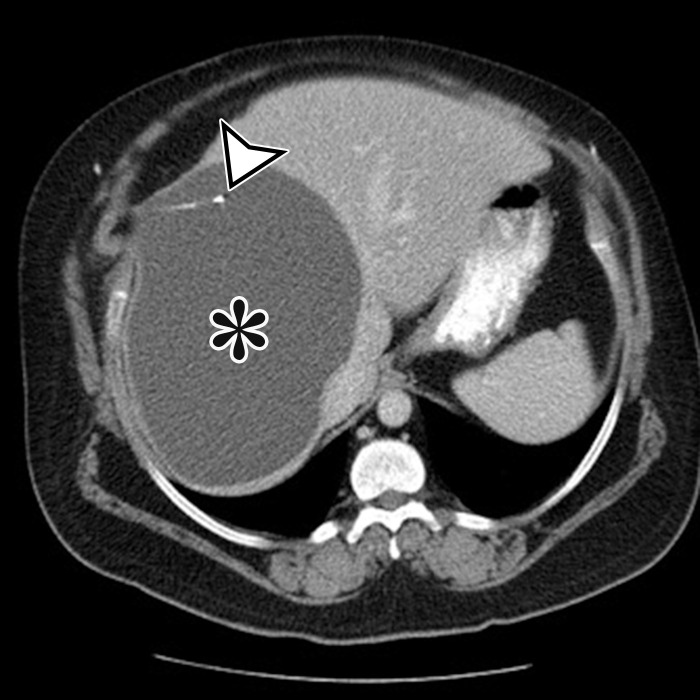 CSF pseudocyst, also known as abdominal peritoneal pseudocyst (APC), in a 49-year-old man with a long-term ventriculoperitoneal (VP) shunt. Axial (a) and sagittal (b) contrast-enhanced CT images show a well-circumscribed thin-walled subcapsular unilocular cyst (*) occupying nearly the entire right lobe of the liver, intimately associated with the distal tip of a VP shunt (arrowhead).