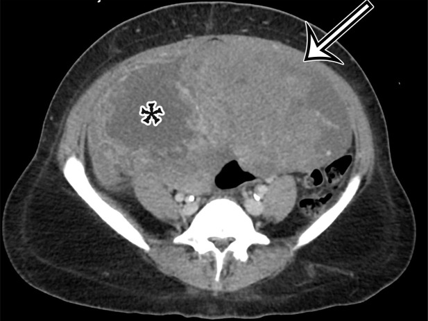 Spectrum of cystic gastrointestinal stromal tumor (GIST) at axial contrast-enhanced CT. (a) Axial contrast-enhanced CT image in a 35-year-old woman with right-sided bulging of the abdomen shows a large unilocular thick-walled cyst in the right abdomen (arrow) with no obvious site of origin. The internal contents have heterogeneous attenuation (*). (b) Axial contrast-enhanced CT image in a 61-year-old man with new-onset abdominal pain similarly shows a large predominantly unilocular cystic mass (*) in the anterior abdomen, with a thick wall (arrow) and mass effect on the pancreas and stomach but no clear site of origin. (c) Axial contrast-enhanced CT image in a 50-year-old woman shows a solid and cystic mass in the anterior abdomen. The cystic components (*) are more loculated, with thick walls and large solid components (arrow), consistent with cystic degeneration of a high-risk GIST.