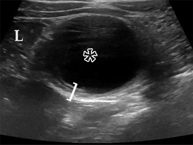 EDC with pathologic correlation. (a) Transabdominal US image at the level of the inferior margin of the liver (L) shows the gut signature sign (also known as the double-wall or five-layer sign) of the EDC wall. The multilayered alternating echogenic appearance resembles normal bowel, with similar innermost hyperechoic mucosa, hypoechoic muscularis mucosa, hyperechoic submucosa, hypoechoic muscularis propia, and outermost hyperechoic serosa (bracket) of the duplicated bowel wall of the EDC (*). This cyst served as the lead point for an intussusception (shown in Fig E5) and was resected. (b) Photograph of a cut gross specimen shows the common wall (arrowheads) of the EDC and subjacent bowel loop. Lumen = small-bowel lumen. (c) Low-power photomicrograph (H-E stain) of an EDC shows the shared wall (*) between the small-bowel loop and EDC. Arrowheads = mucosae.