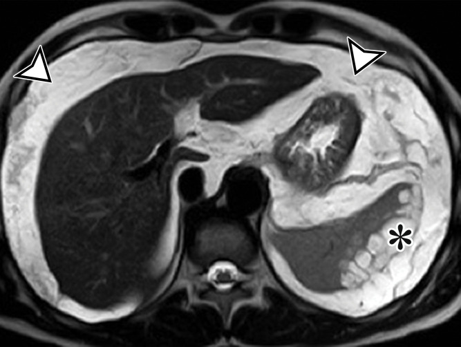 PMP (disseminated peritoneal adenomucinosis [DPAM]) in a 50-year-old man with progressive abdominal distention, early satiety, and weight loss due to a ruptured low-grade appendiceal mucinous neoplasm (LAMN). (a, b) Axial(a) and coronal (b) T2-weighted images show heterogeneously T2-hyperintense mucin (arrowheads) surrounding the liver and stomach, with subcapsular splenic implants (* in a). Close examination of the coronal image shows marked distention of the appendix (arrow in b) with a “pear” or “chicken drumstick” appearance. (c) Photograph of the cut resected spleen shows subcapsular splenic implants (*), which correlate with those seen at MRI. (d) Low-power photomicrograph of the appendix (H-E stain) shows loss of the normal mucosal architecture with proliferation of columnar mucinous epithelial cells (arrowhead), which produce mucinous content. The mucin (*) distends the appendiceal lumen and dissects through the ruptured wall (arrows), where it implanted diffusely along the peritoneal surface, leading to PMP.