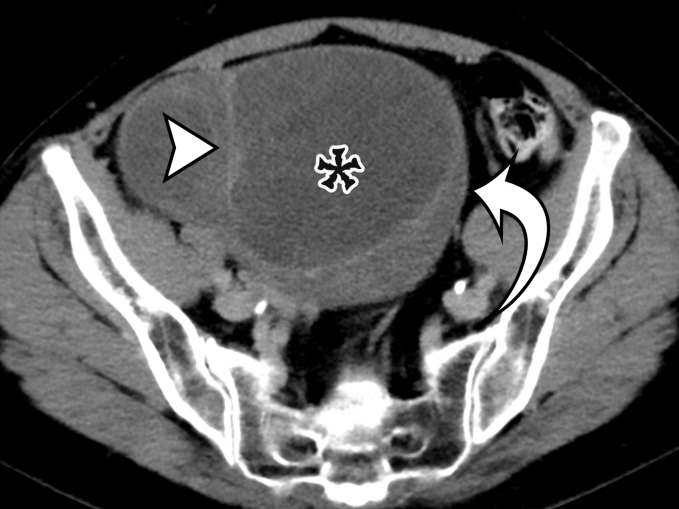 Spectrum of cystic-appearing soft-tissue tumors. (a) Axial contrast-enhanced CT image in a 62-year-old woman with a palpable abdominal mass shows a large thick-walled multi­loculated cystic mass (*) with septa (arrowhead) and solid nodu­lar components (arrow). It was pathologically confirmed to be dedifferentiated liposarcoma with myxoid components, which corresponded to the cystic spaces. (b) Coronal contrast-enhanced CT image in an 18-year-old woman with abdominal distention and pain shows a massive predominantly solid mass with several cystic components (*). At histopathologic evaluation, the cystic components corresponded to areas of myxoid stroma within a spindle cell tumor, consistent with desmoid tumor. Desmoid tumors have invasive properties and tend to damage blood vessels.