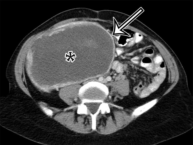 Spectrum of cystic gastrointestinal stromal tumor (GIST) at axial contrast-enhanced CT. (a) Axial contrast-enhanced CT image in a 35-year-old woman with right-sided bulging of the abdomen shows a large unilocular thick-walled cyst in the right abdomen (arrow) with no obvious site of origin. The internal contents have heterogeneous attenuation (*). (b) Axial contrast-enhanced CT image in a 61-year-old man with new-onset abdominal pain similarly shows a large predominantly unilocular cystic mass (*) in the anterior abdomen, with a thick wall (arrow) and mass effect on the pancreas and stomach but no clear site of origin. (c) Axial contrast-enhanced CT image in a 50-year-old woman shows a solid and cystic mass in the anterior abdomen. The cystic components (*) are more loculated, with thick walls and large solid components (arrow), consistent with cystic degeneration of a high-risk GIST.