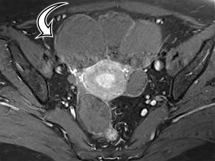 Peritoneal hydatidosis in an asymp­tomatic 49-year-old woman. (a, b) Axial CT images through the lower abdomen (a) and pelvis (b) show multiple well-circumscribed cystic lesions. The cyst along the posterior margin of the liver (arrow in a) has smooth mural calcifications. The cysts in the left upper quadrant (arrowhead in a) and pelvis (arrowhead in b) have a multiloculated appearance, with internal cysts of differing attenuation. (c) Sagittal T2-weighted image better shows the internal cyst architecture, including the floating inner membrane (straight arrow); the posterior pelvic cyst wall (curved arrow) is markedly T2 hypointense owing to the abundant collagen content. (d) Axial contrast-enhanced T1-weighted image shows enhancement of the thin walls and septa (arrow) but no internal nodularity or enhancement. Intraoperatively, there were innumerable hydatid cysts studding the peritoneum in addition to the multiple abdominal and pelvic cysts, consistent with disseminated hydatidosis, presumed secondary to a ruptured hepatic hydatid cyst.