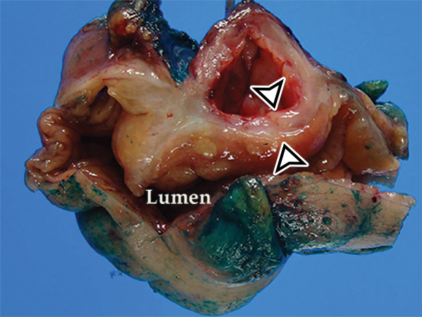 EDC with pathologic correlation. (a) Transabdominal US image at the level of the inferior margin of the liver (L) shows the gut signature sign (also known as the double-wall or five-layer sign) of the EDC wall. The multilayered alternating echogenic appearance resembles normal bowel, with similar innermost hyperechoic mucosa, hypoechoic muscularis mucosa, hyperechoic submucosa, hypoechoic muscularis propia, and outermost hyperechoic serosa (bracket) of the duplicated bowel wall of the EDC (*). This cyst served as the lead point for an intussusception (shown in Fig E5) and was resected. (b) Photograph of a cut gross specimen shows the common wall (arrowheads) of the EDC and subjacent bowel loop. Lumen = small-bowel lumen. (c) Low-power photomicrograph (H-E stain) of an EDC shows the shared wall (*) between the small-bowel loop and EDC. Arrowheads = mucosae.