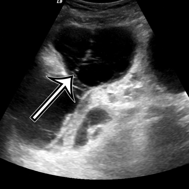 Cystic lymphangioma in a 33-year-old woman with a 2-week history of right lower quadrant pain, with pathologic correlation. (a, b) Transverse US (a) and axial contrast-enhanced CT (b) images show a thin-walled multiloculated cyst containing thin septa (arrow) that insinuates around the colon.(c) Photograph of the cut gross specimen shows the multilocular nature of the lymphangioma, with cystic spaces of varying size (*) and thin septa (arrow). (d) Photomicrograph of a cystic lymphangioma shows multiple thin-walled cystic spaces lined with endothelial cells and containing lymph (*). (MRI features are shown in Figure E1.)