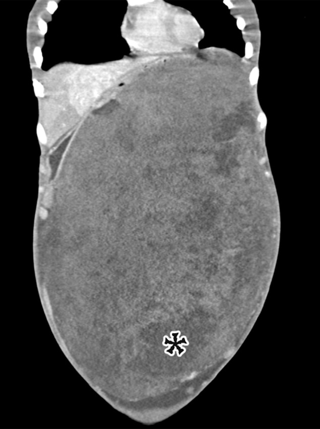 Spectrum of cystic-appearing soft-tissue tumors. (a) Axial contrast-enhanced CT image in a 62-year-old woman with a palpable abdominal mass shows a large thick-walled multi­loculated cystic mass (*) with septa (arrowhead) and solid nodu­lar components (arrow). It was pathologically confirmed to be dedifferentiated liposarcoma with myxoid components, which corresponded to the cystic spaces. (b) Coronal contrast-enhanced CT image in an 18-year-old woman with abdominal distention and pain shows a massive predominantly solid mass with several cystic components (*). At histopathologic evaluation, the cystic components corresponded to areas of myxoid stroma within a spindle cell tumor, consistent with desmoid tumor. Desmoid tumors have invasive properties and tend to damage blood vessels.